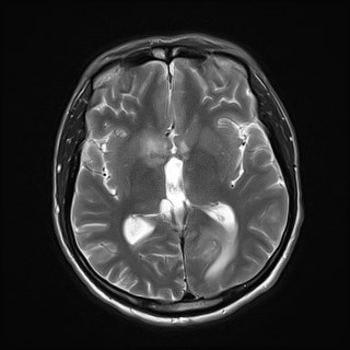 File:Cerebral toxoplasmosis (Radiopaedia 43956-47461 Axial T2 11).jpg