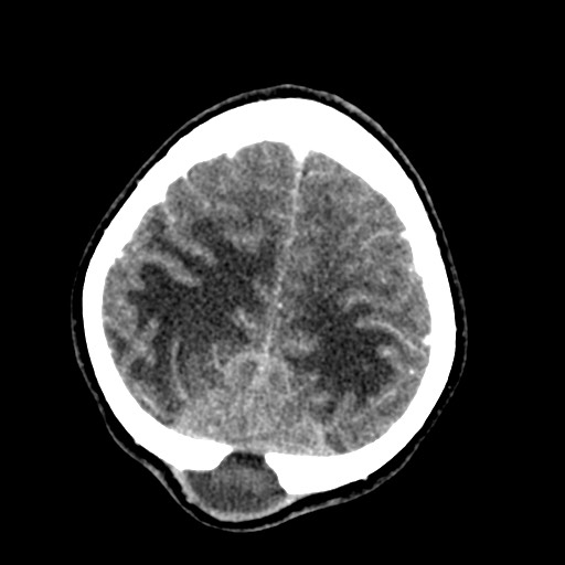 Cerebral tuberculosis with dural sinus invasion (Radiopaedia 60353-68019 Axial C+ delayed 55).jpg