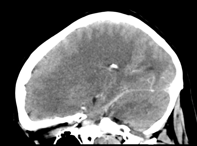 Cerebral venous hemorrhagic infarction (Radiopaedia 57576-64538 Sagittal C+ 22).png