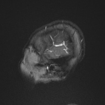 Cerebral venous infarction - hemorrhagic (Radiopaedia 81625-95505 Sagittal MRV 8).jpg