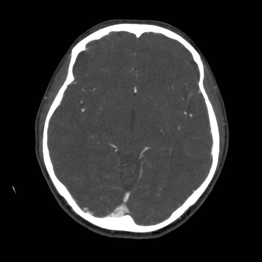 Cerebral venous sinus thrombosis (Radiopaedia 40619-43227 A 104).jpg