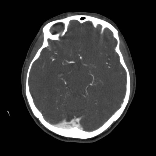 Cerebral venous sinus thrombosis (Radiopaedia 40619-43227 A 94).jpg