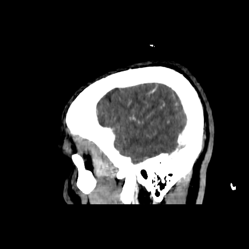 File:Cerebral venous thrombosis (CVT) (Radiopaedia 77524-89685 Sagittal CTV 43).jpg