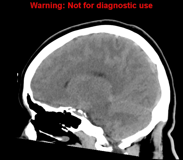 File:Cerebral venous thrombosis (Radiopaedia 37224-38992 B 18).jpg