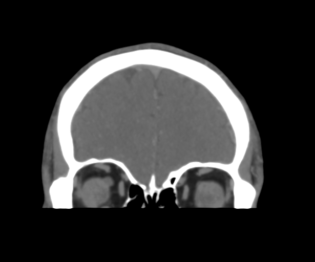 Cerebral venous thrombosis (Radiopaedia 38392-40467 Coronal CTA-Venogram 13).png