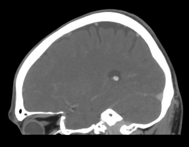 Cerebral venous thrombosis (Radiopaedia 38392-40467 D 17).png