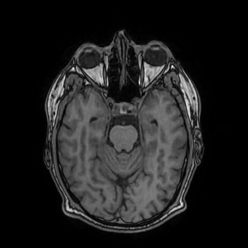 Cerebral venous thrombosis with secondary intracranial hypertension (Radiopaedia 89842-106957 Axial T1 73).jpg