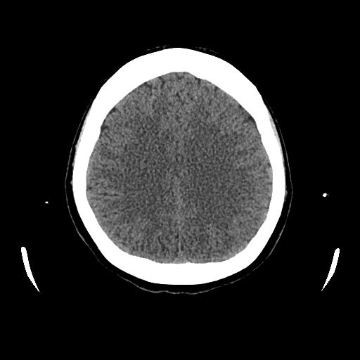 Cerebral venous thrombosis with venous hemorrhagic infarct (Radiopaedia 90354-107660 Axial non-contrast 35).jpg