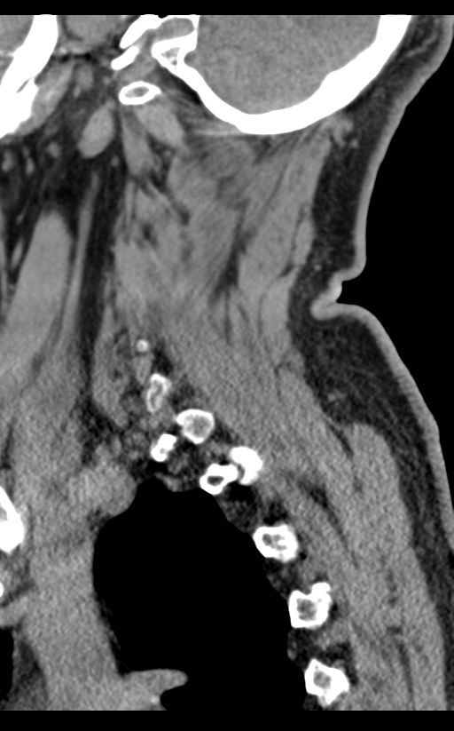 Cervical canal stenosis due to ossification of the posterior longitudinal ligament (Radiopaedia 47260-51823 D 64).png