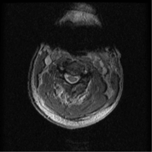 Cervical canal stenosis with cord compression (Radiopaedia 34114-35374 Axial Gradient Echo 68).png