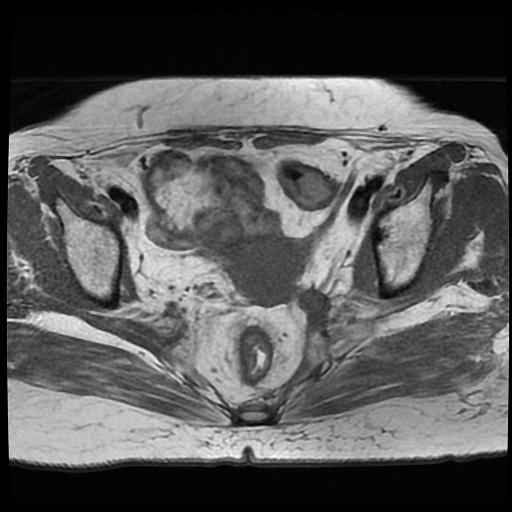 File:Cervical carcinoma (Radiopaedia 70924-81132 Axial T1 7).jpg
