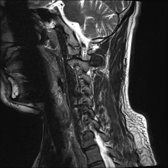 File:Cervical disc extrusion (Radiopaedia 53950-60077 Sagittal T2 14).jpg