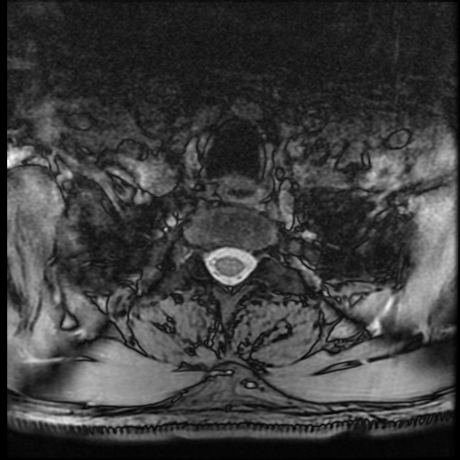 Cervical disc extrusion (Radiopaedia 59074-66364 G 103).jpg