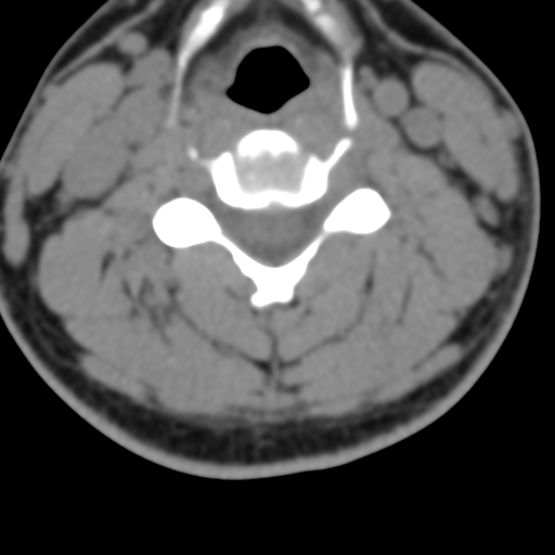 Cervical schwannoma (Radiopaedia 57979-64974 Axial non-contrast 34).png