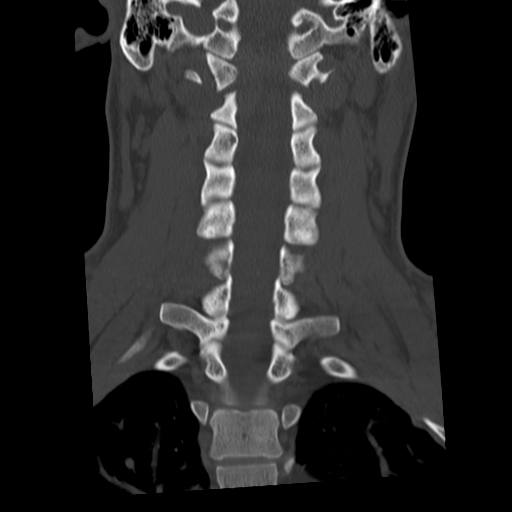 Cervical schwannoma (Radiopaedia 57979-64974 Coronal bone window 33).png