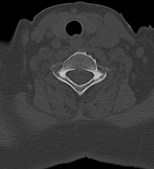 Cervical spine ACDF loosening (Radiopaedia 48998-54070 Axial bone window 44).png
