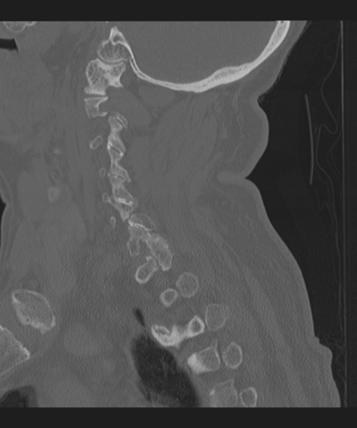 Cervical spine fracture in the setting of ankylosis (Radiopaedia 37038-38715 Sagittal bone window 56).png