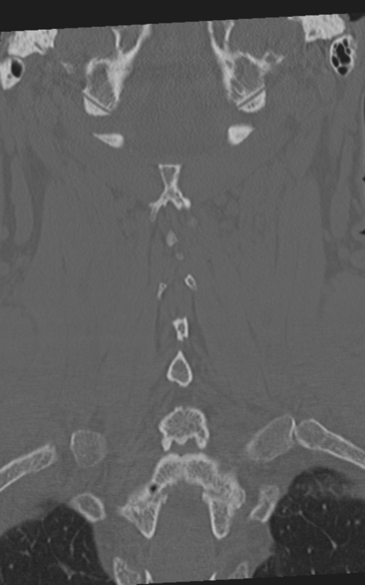 Cervical spine fractures with vertebral artery dissection (Radiopaedia 53296-59268 Coronal bone window 49).png