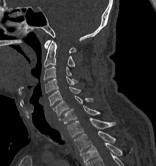 Cervical spine trauma with tear drop fracture and perched facet joint (Radiopaedia 53989-60127 Sagittal bone window 82).jpg