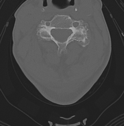 Cervical spondylolysis (Radiopaedia 49616-54811 Axial bone window 28).png
