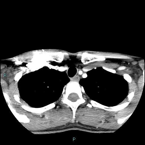 Cervical thymic cyst (Radiopaedia 88632-105335 B 21).jpg