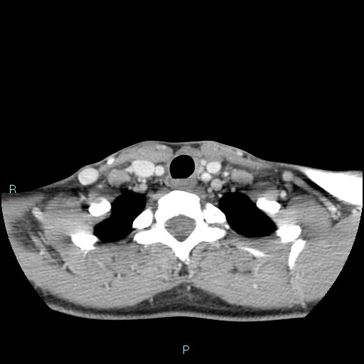 Cervical thymic cyst (Radiopaedia 88632-105335 C 34).jpg
