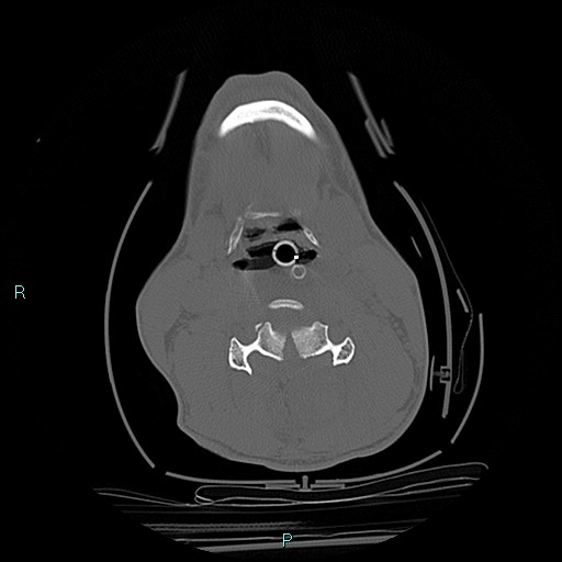 File:Cervical vertebral burst fracture (Radiopaedia 37420-39258 Axial bone window 34).jpg