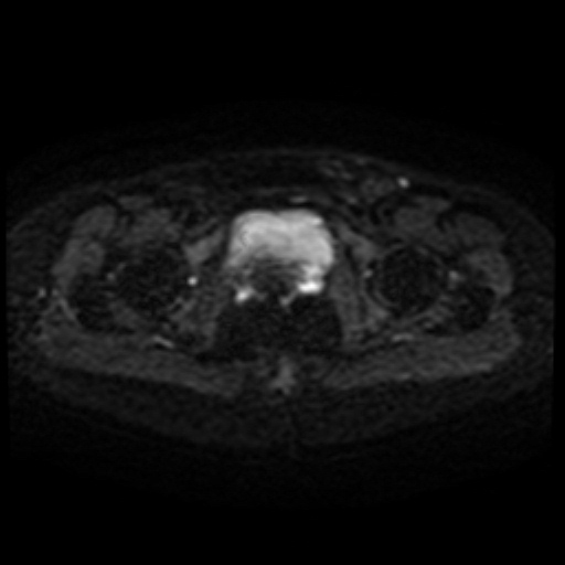 Cesarian section scar endometriosis (Radiopaedia 66520-75799 Axial DWI 45).jpg