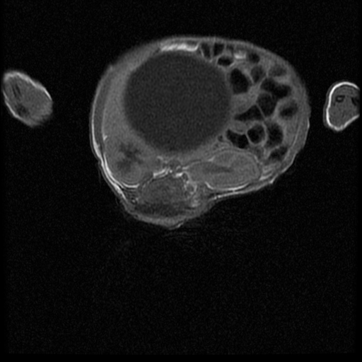 File:Chiari II malformation with spinal meningomyelocele (Radiopaedia 23550-23652 Axial T1 12).jpg