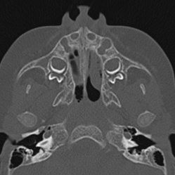 Choanal atresia (Radiopaedia 88525-105975 Axial bone window 20).jpg