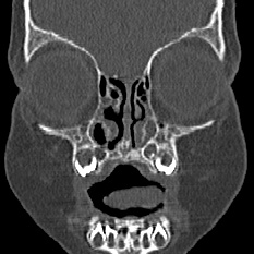 Choanal atresia (Radiopaedia 88525-105975 Coronal bone window 14).jpg