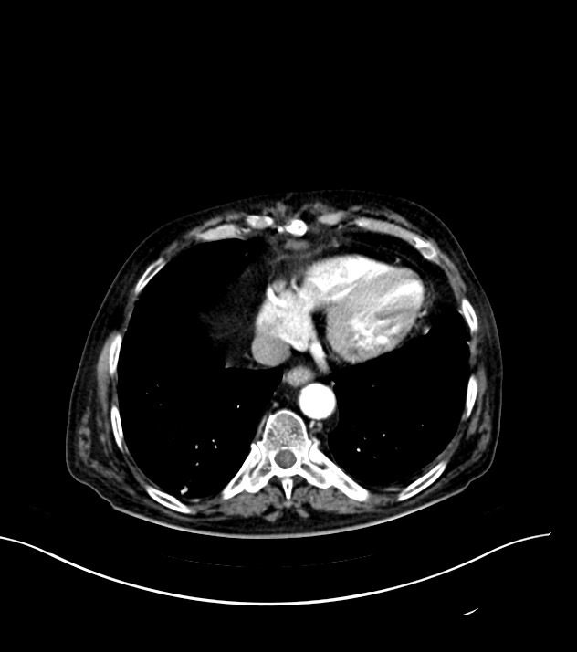 Cholangiocarcinoma with cerebral metastases (Radiopaedia 83519-98629 B 3).jpg