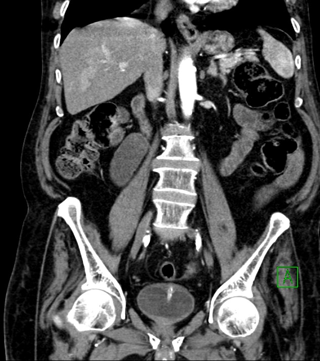 Cholangiocarcinoma with cerebral metastases (Radiopaedia 83519-98629 E 50).jpg