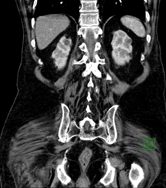 Cholangiocarcinoma with cerebral metastases (Radiopaedia 83519-98629 E 68).jpg