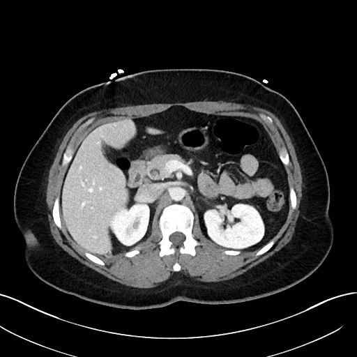 File:Choledocholithiasis after recent cholecystectomy (Radiopaedia 60929-68737 Axial 23).jpg