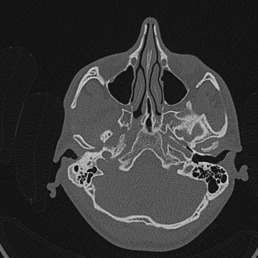 Cholesteatoma (Radiopaedia 70429-80529 Axial bone window 74).jpg