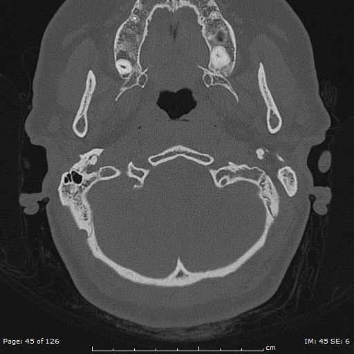 Cholesteatoma - external auditory canal (Radiopaedia 88452-105096 Axial bone window 8).jpg