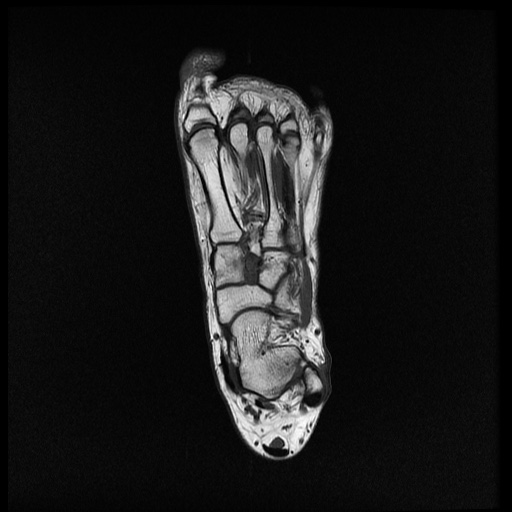 File:Chondroblastoma - midfoot (Radiopaedia 64831-73765 Long axis T1 13).jpg