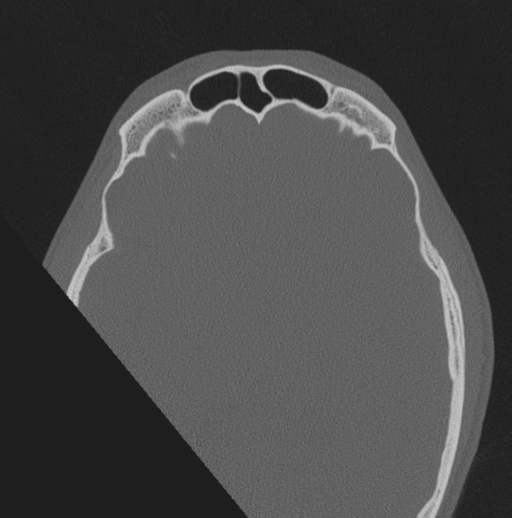 Chondrosarcoma (clivus) (Radiopaedia 46895-51425 Axial bone window 6).png