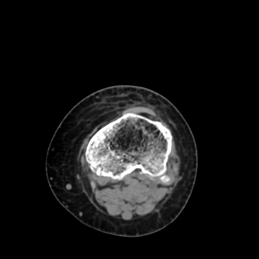 Chondrosarcoma - femur (Radiopaedia 64187-72954 Axial non-contrast 67).jpg