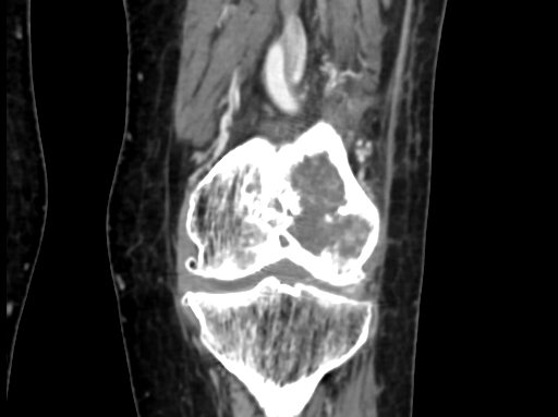 Chondrosarcoma - femur (Radiopaedia 64187-72954 C 34).jpg