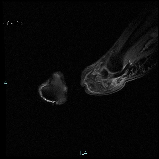 File:Chondrosarcoma - phalanx (Radiopaedia 69047-78813 Sagittal PD fat sat 12).jpg