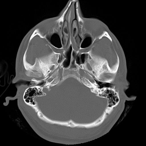 File:Chondrosarcoma - sphenoid wing (Radiopaedia 58259-67828 Axial bone window 4).jpg