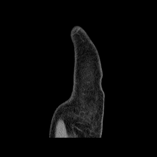 Chondrosarcoma of iliac wing (Radiopaedia 63861-72599 F 9).jpg