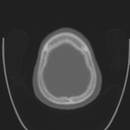 Chondrosarcoma of skull base- grade II (Radiopaedia 40948-43653 Axial bone window 44).png
