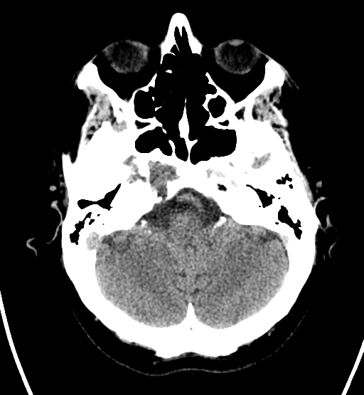 File:Chondrosarcoma of skull base- grade II (Radiopaedia 40948-43653 Axial non-contrast 6).png
