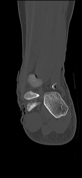 Chopart fracture (Radiopaedia 35347-36851 Coronal bone window 21).jpg