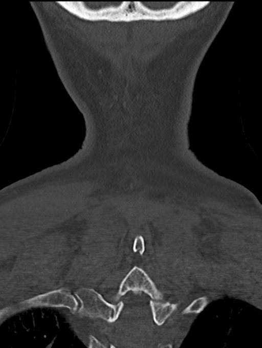 Chordoma (C4 vertebra) (Radiopaedia 47561-52188 Coronal bone window 58).png