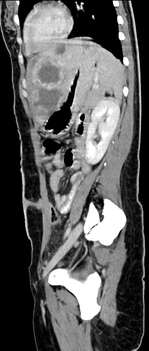 Choriocarcinoma liver metastases (Radiopaedia 74768-85766 C 73).jpg