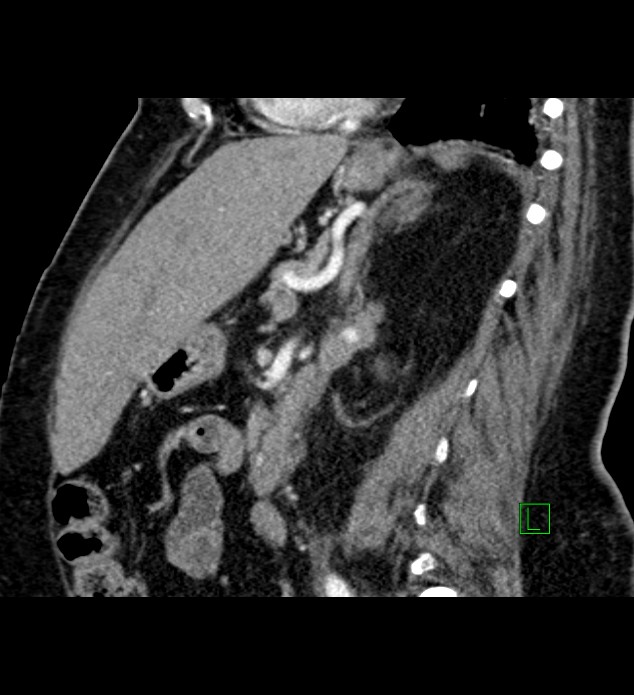 Chromophobe renal cell carcinoma (Radiopaedia 84239-99519 D 53).jpg